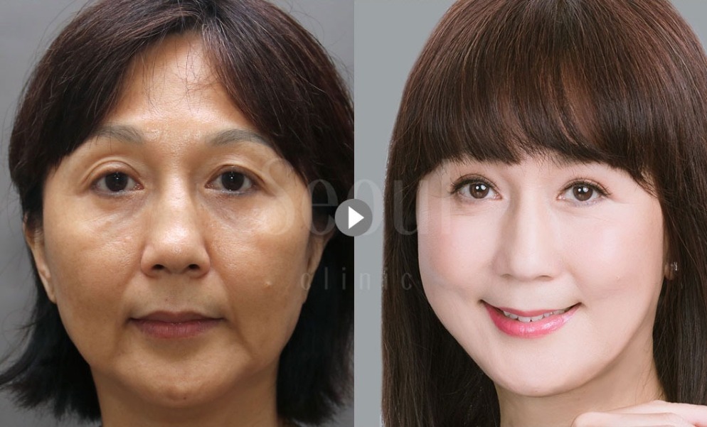 首尔医美hd微创内视镜拉皮手术案例术前术后照片对比