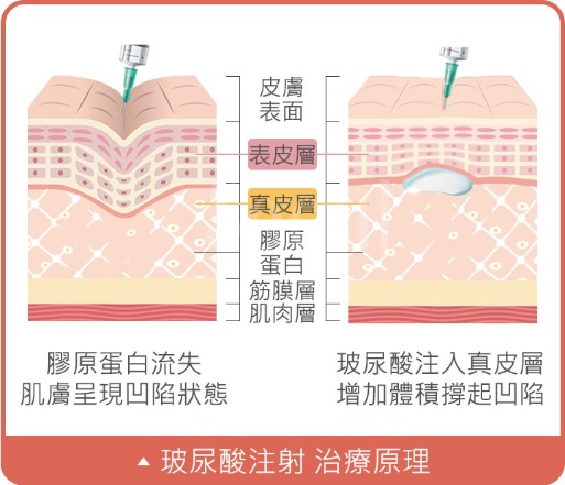 瑞絲朗-治療原理-首爾醫美