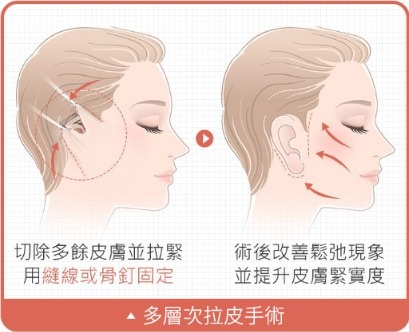 拉皮_傳統拉皮手術_首爾醫美 拉皮_傳統拉皮手術_首爾醫美