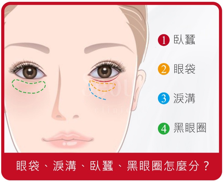 眼袋 淚溝 臥蠶 黑眼圈怎麼分 一篇讓你看懂如何有效消除眼袋