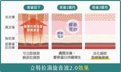 立特拉渦旋音波2.0-治療效果-首爾醫美