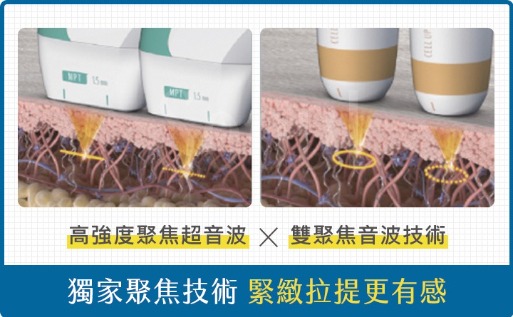 海芙音波-海芙音波第四代「媚必提」獨家聚焦技術，緊緻拉提更有感-首爾醫美