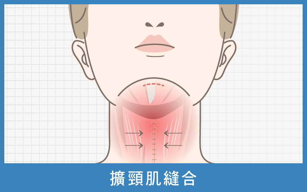 天鵝頸手術-天鵝頸手術第三步擴頸肌縫合-首爾醫美