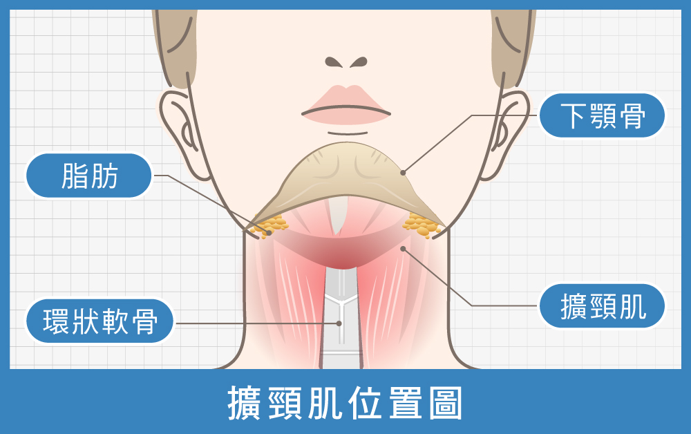 天鵝頸手術-擴頸肌位置圖-首爾醫美