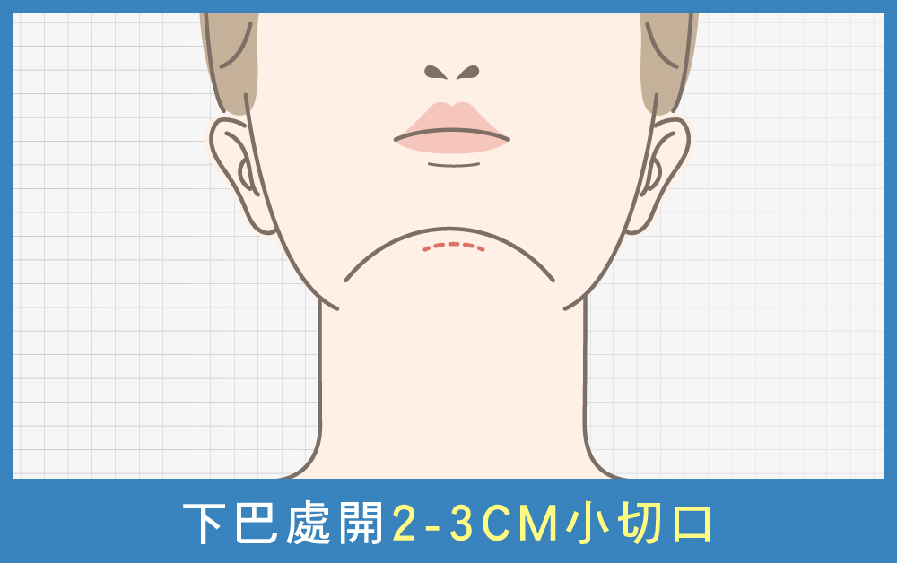 天鵝頸手術-天鵝頸手術第一步在下巴下緣處開一個約2cm的隱痕小切口-首爾醫美