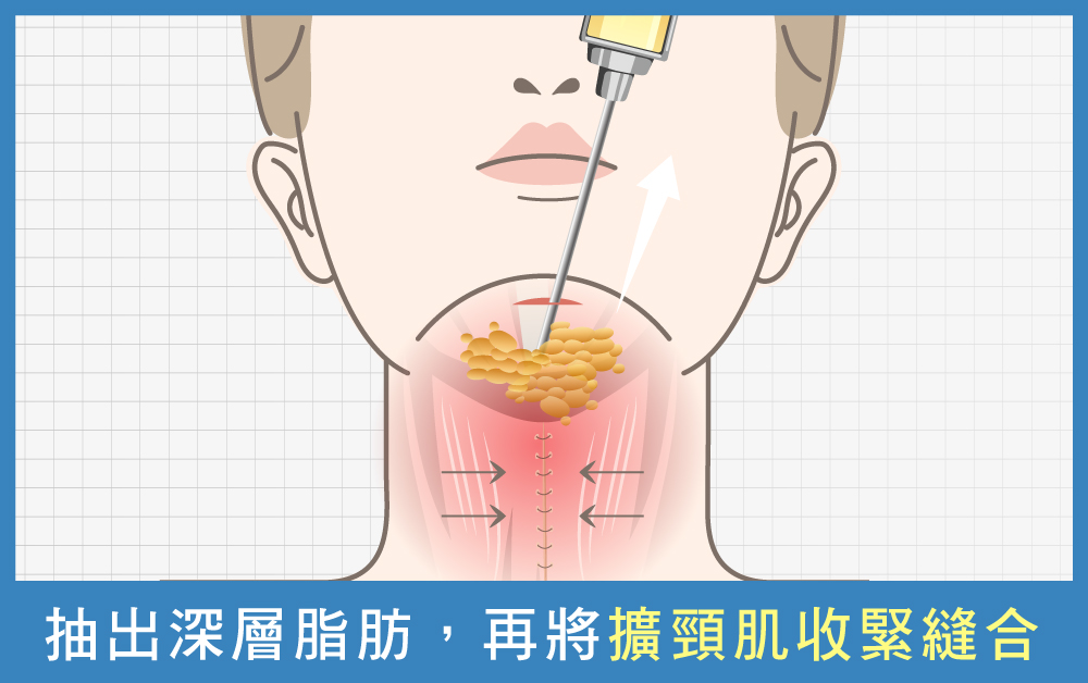 天鵝頸手術-消除雙下巴療程1：天鵝頸手術-首爾醫美