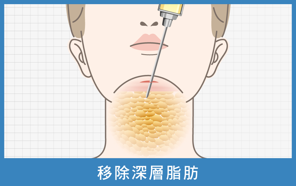 天鵝頸手術-天鵝頸手術第二步移除深層脂肪-首爾醫美