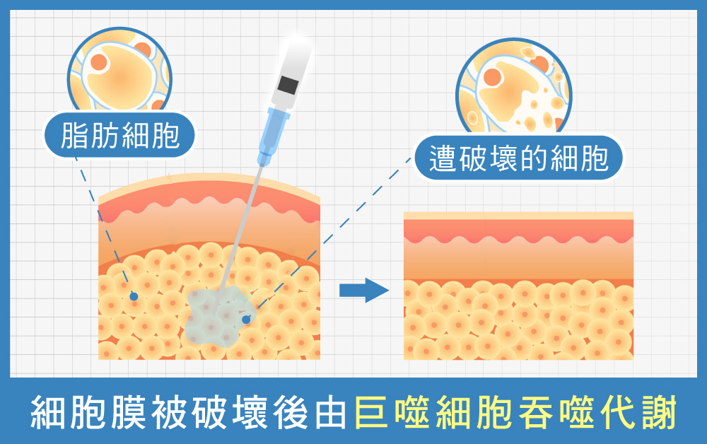 天鵝頸手術-消除雙下巴療程2：消脂針-首爾醫美