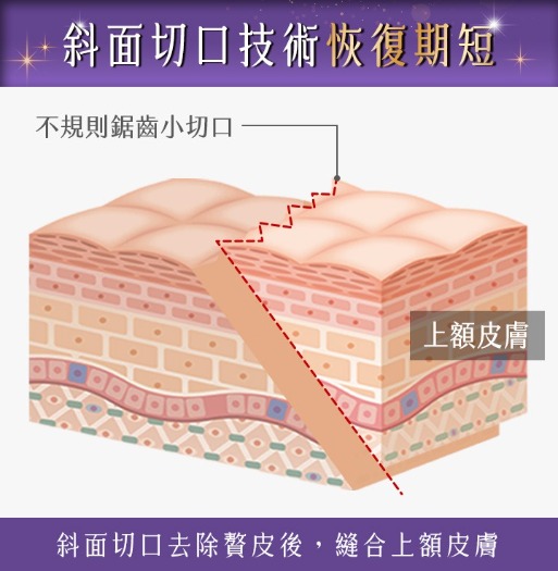 埋線隆鼻_五大優勢3-埋線隆鼻技術_首爾醫美