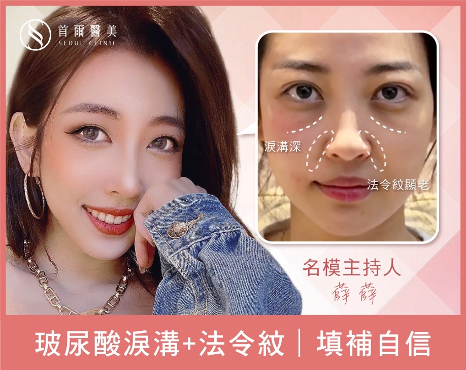玻尿酸淚溝+玻尿酸法令紋-名模主持人薛薛-首爾醫美診所 玻尿酸淚溝+玻尿酸法令紋-名模主持人薛薛-首爾醫美診所