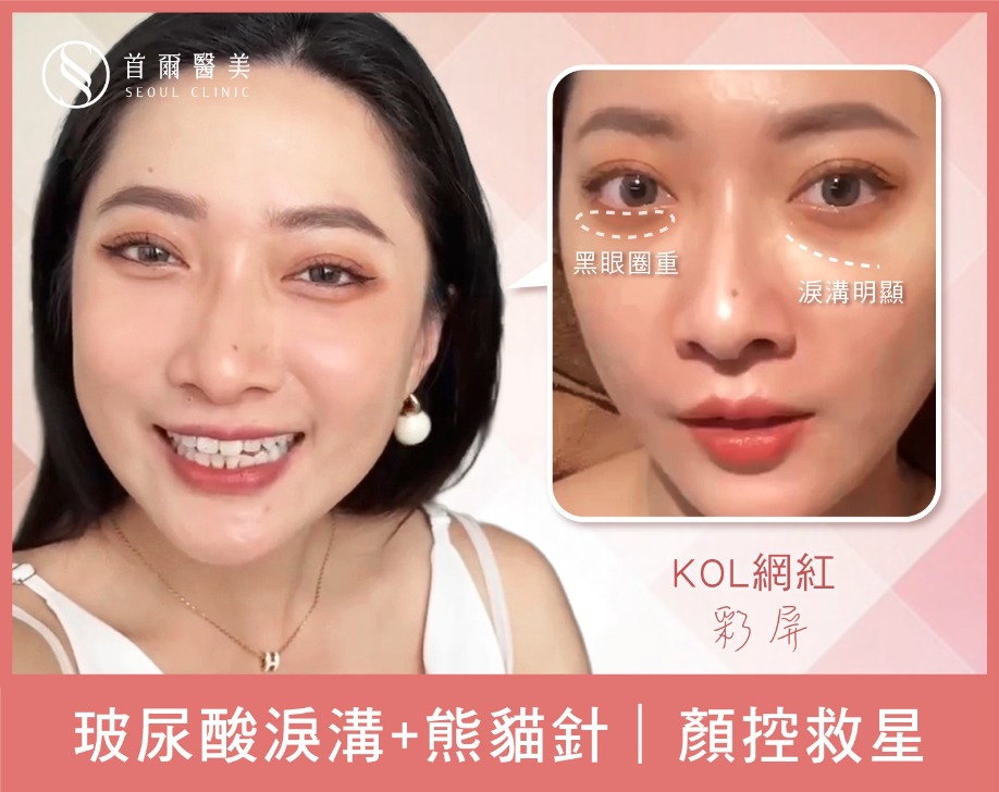 玻尿酸淚溝填補-KOL網紅彩屏-首爾醫美診所 玻尿酸淚溝填補-KOL網紅彩屏-首爾醫美診所