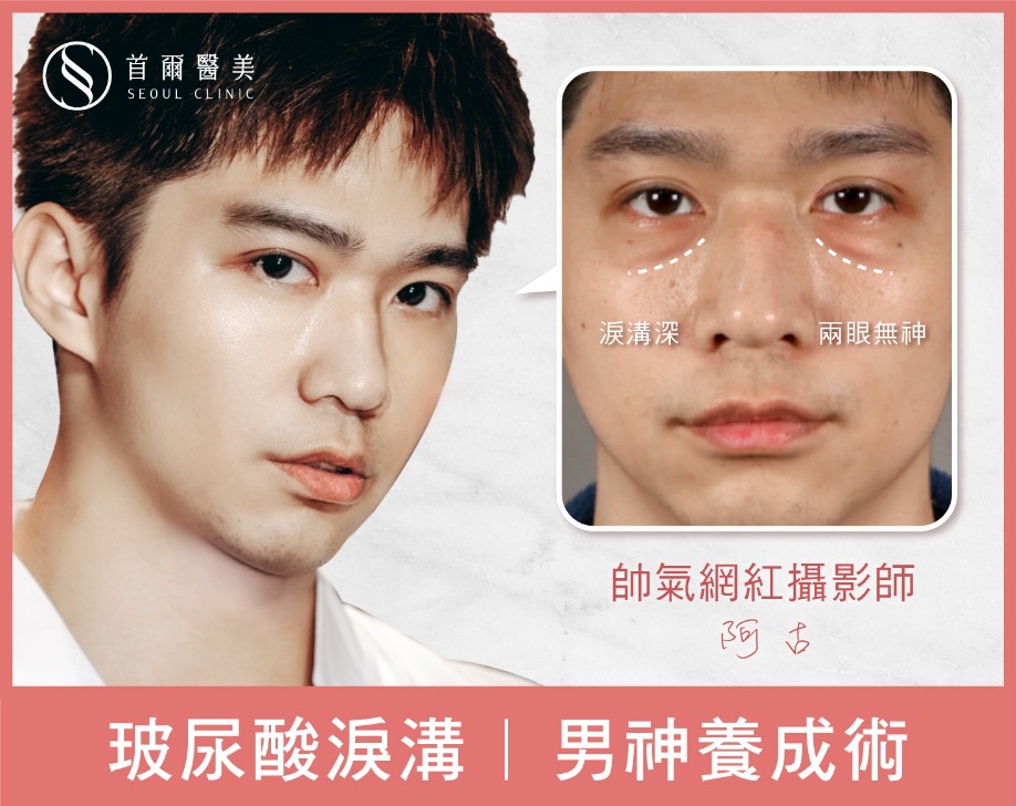 玻尿酸淚溝-帥氣網紅攝影師阿古-首爾醫美組診所 玻尿酸淚溝-帥氣網紅攝影師阿古-首爾醫美組診所
