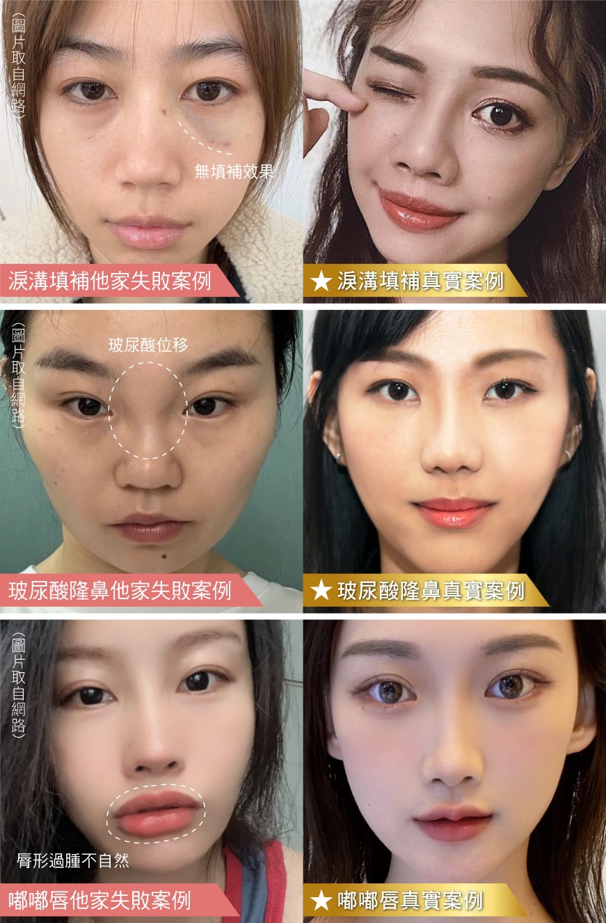 玻尿酸失敗案例分享-玻尿酸風險、失敗原因-首爾醫美診所 玻尿酸失敗案例分享-玻尿酸風險、失敗原因-首爾醫美診所