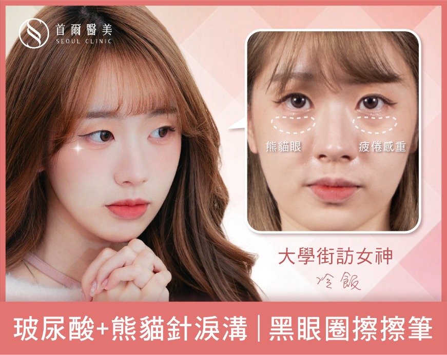 玻尿酸淚溝案例分享-接訪女神冷飯-玻尿酸+熊貓針淚溝黑眼圈-首爾醫美診所 玻尿酸淚溝案例分享-接訪女神冷飯-玻尿酸+熊貓針淚溝黑眼圈-首爾醫美診所